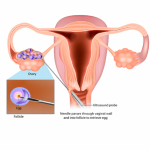 Best IVF Centre in Gurgaon